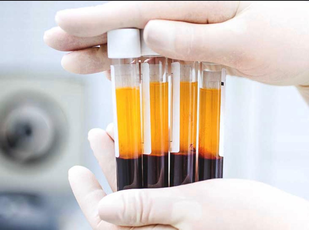 Platelet-Rich Plasma (PRP)